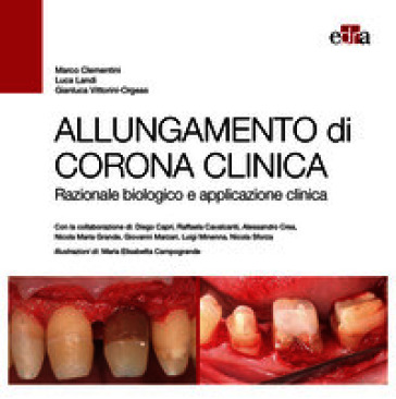 Allungamento di corona clinica. Razionale biologico e applicazione clinica