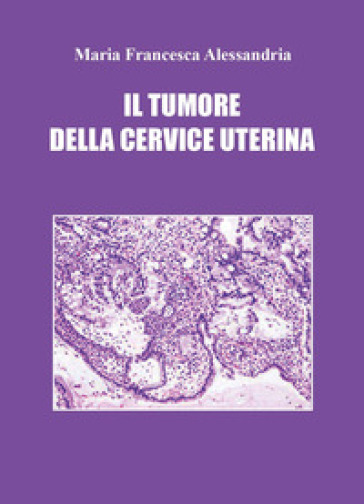 Il tumore della cervice uterina